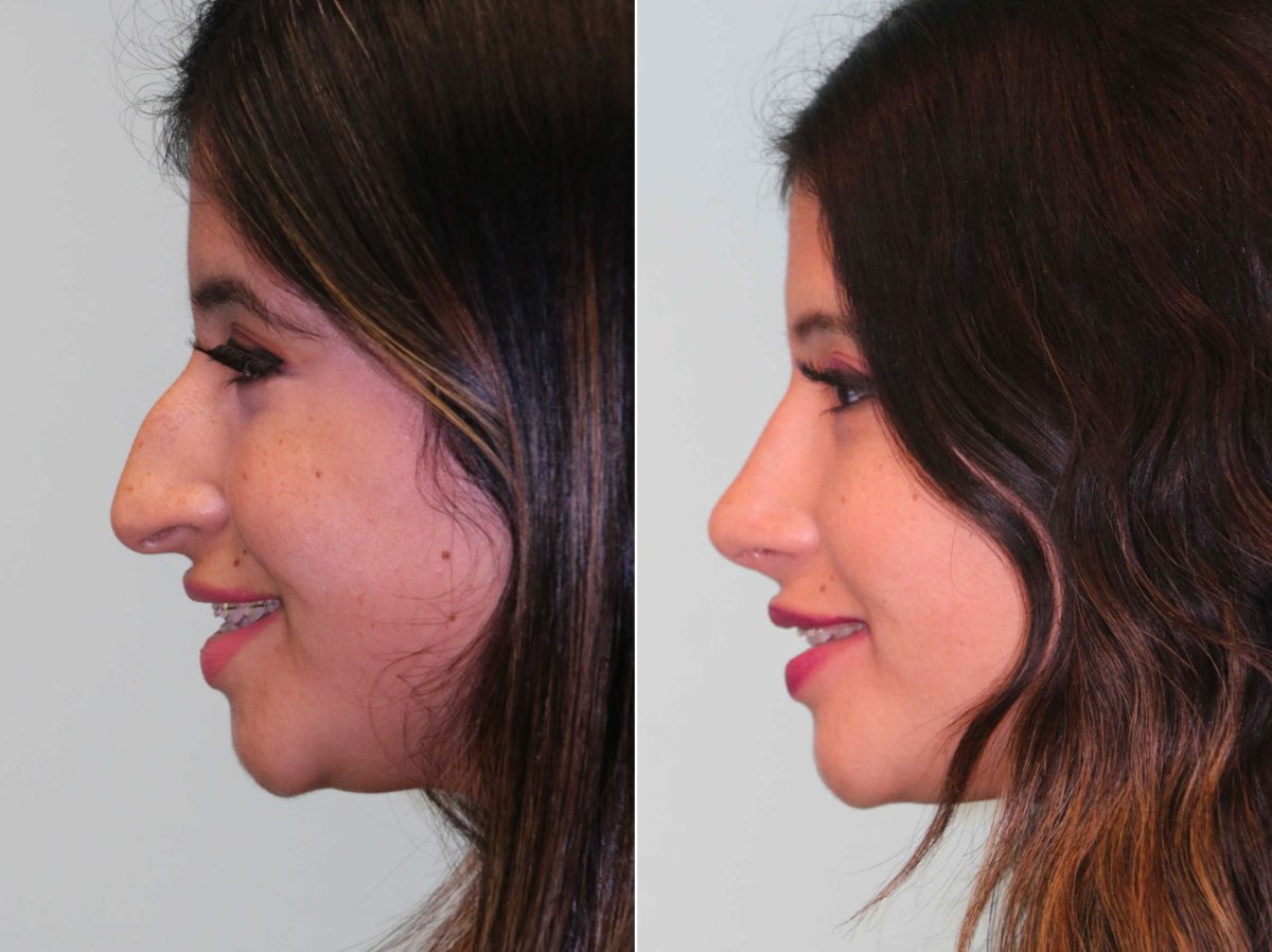 Before and after Rhinoplasty by Dr. Shervin Naderi, Patient 13069