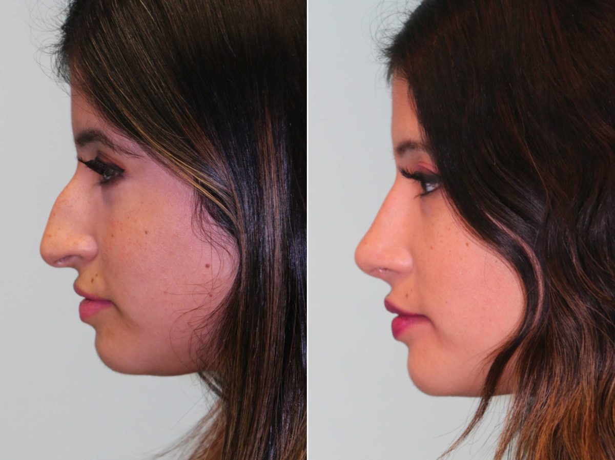 Before and after Rhinoplasty by Dr. Shervin Naderi, Patient 13069