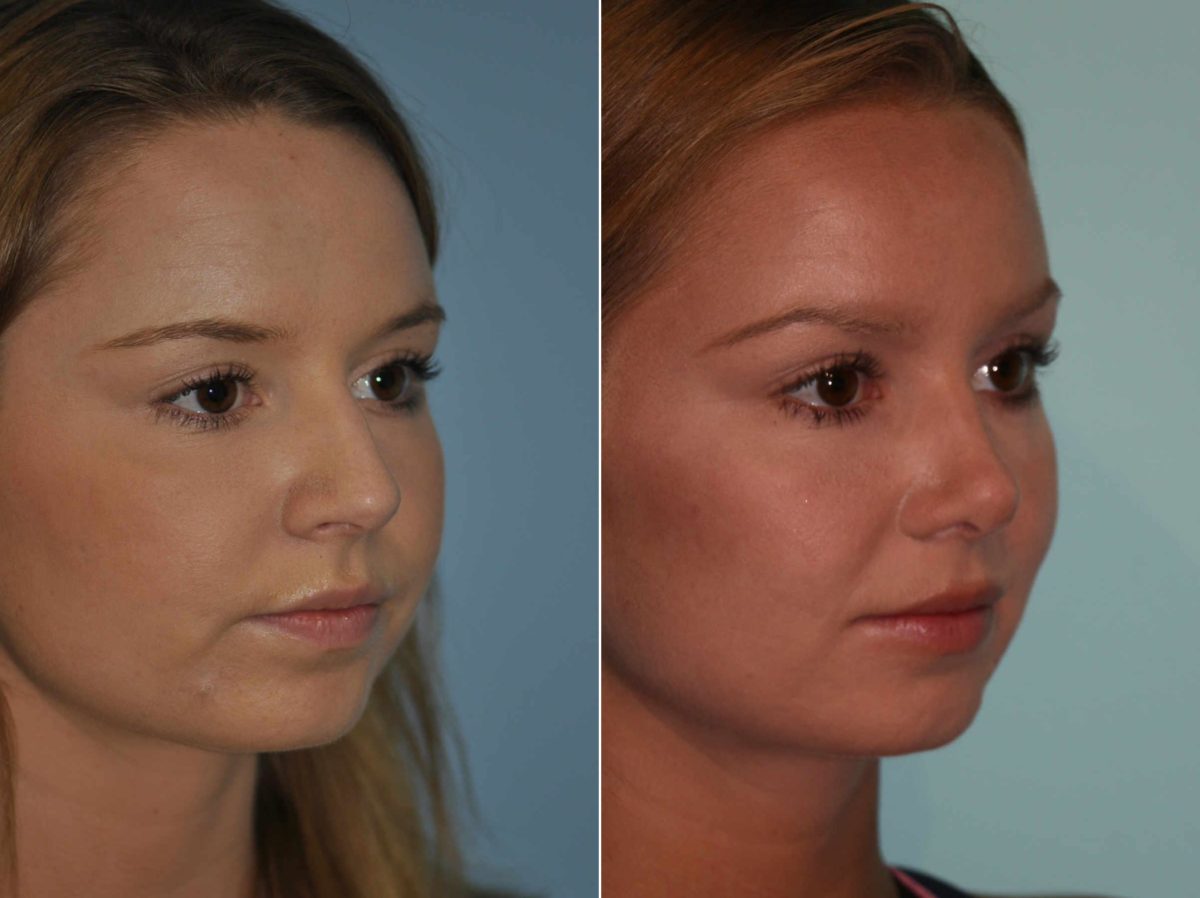 Before and after Rhinoplasty by Dr. Shervin Naderi, Patient 13221