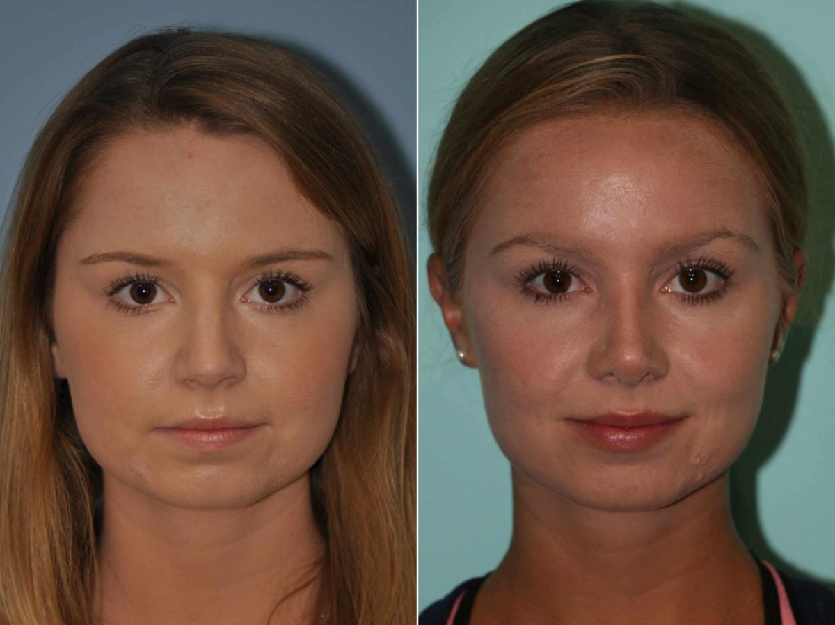 Before and after Rhinoplasty by Dr. Shervin Naderi, Patient 13221