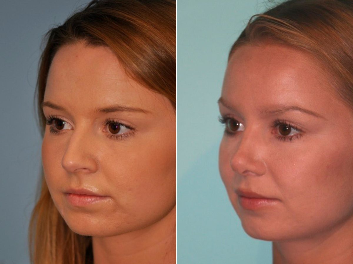 Before and after Rhinoplasty by Dr. Shervin Naderi, Patient 13221