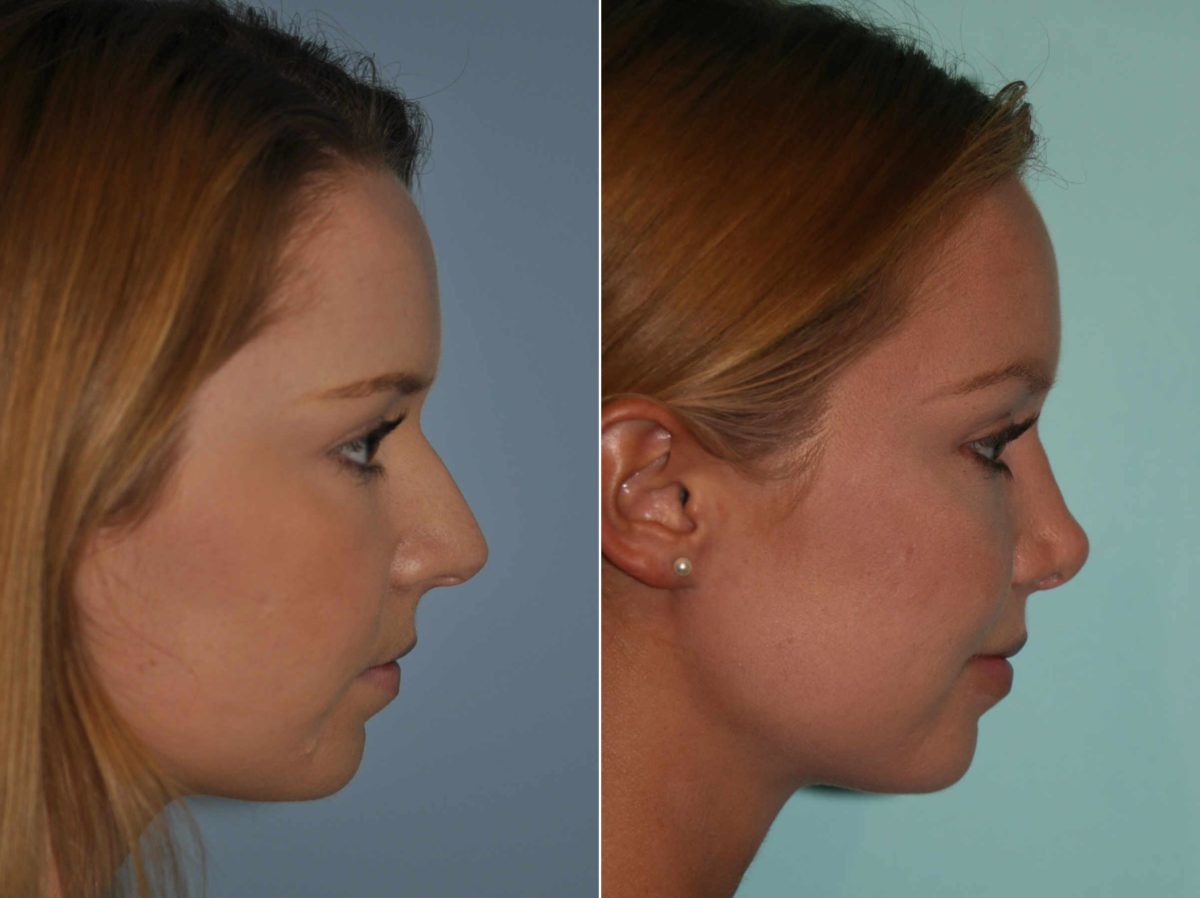 Before and after Rhinoplasty by Dr. Shervin Naderi, Patient 13221