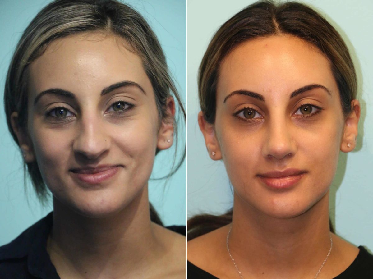 Before and after Rhinoplasty by Dr. Shervin Naderi, Patient 13386