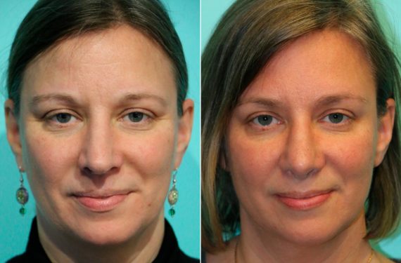 Before and after Rhinoplasty by Dr. Shervin Naderi, Patient 13436