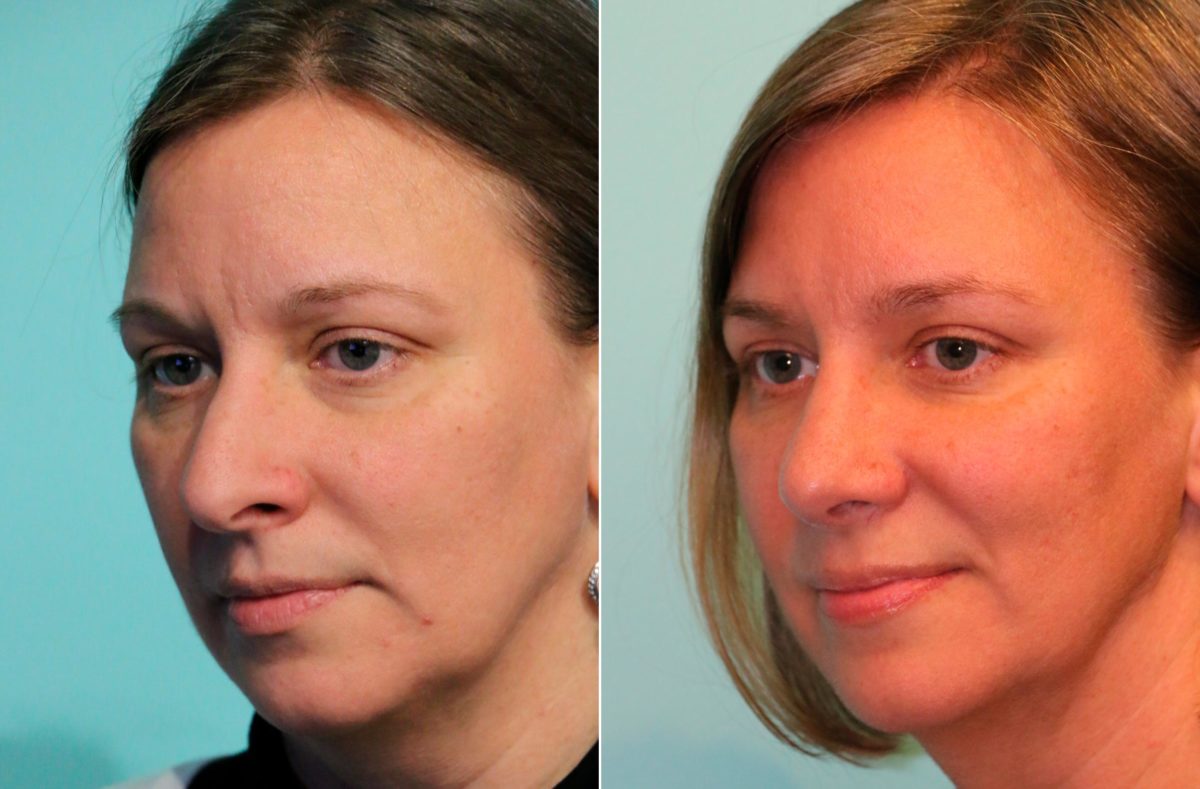 Before and after Rhinoplasty by Dr. Shervin Naderi, Patient 13436