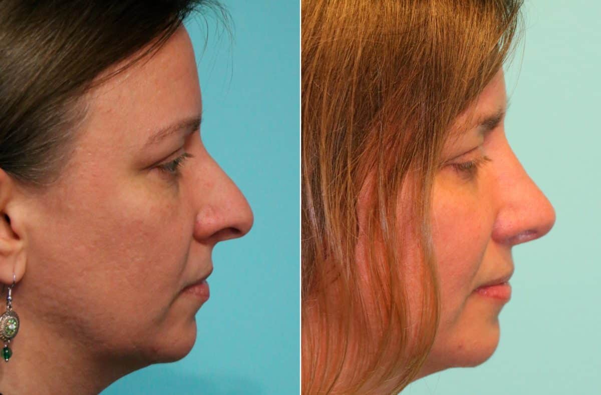 Before and after Rhinoplasty by Dr. Shervin Naderi, Patient 13436