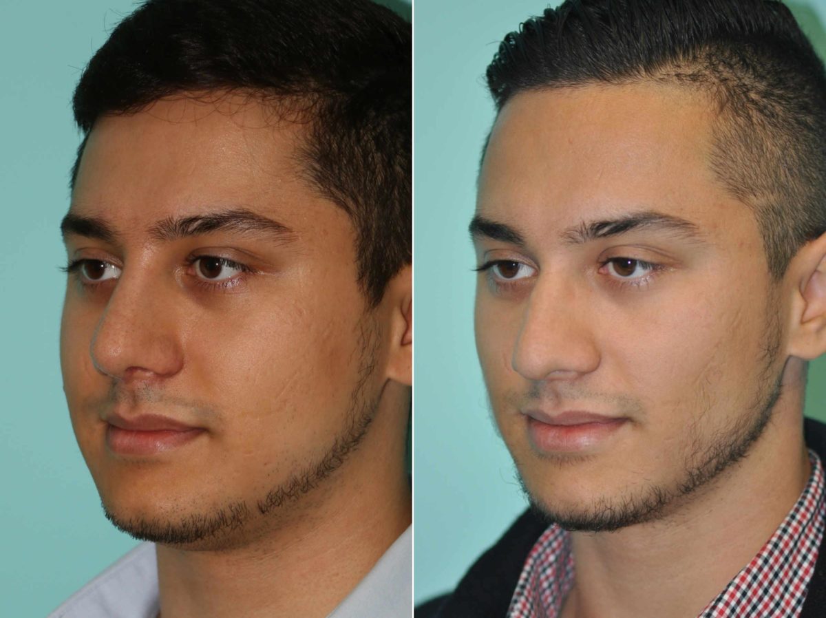 Before and after Rhinoplasty by Dr. Shervin Naderi, Patient 13381