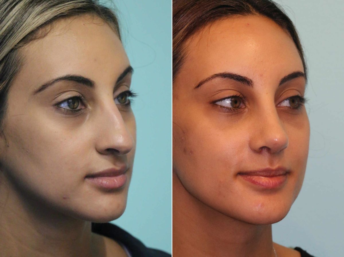 Before and after Rhinoplasty by Dr. Shervin Naderi, Patient 13386