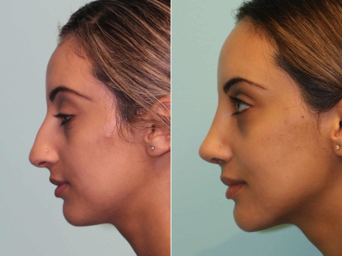 Before and after Rhinoplasty by Dr. Shervin Naderi, Patient 13386