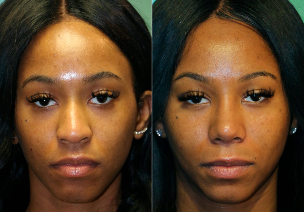 Before and after Rhinoplasty by Dr. Shervin Naderi, Patient 13410