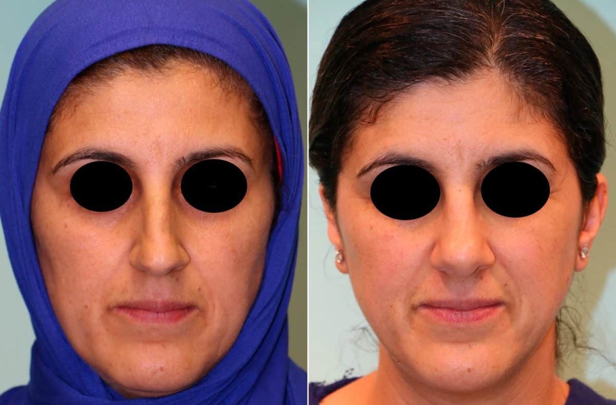 Before and after Rhinoplasty by Dr. Shervin Naderi, Patient 13424