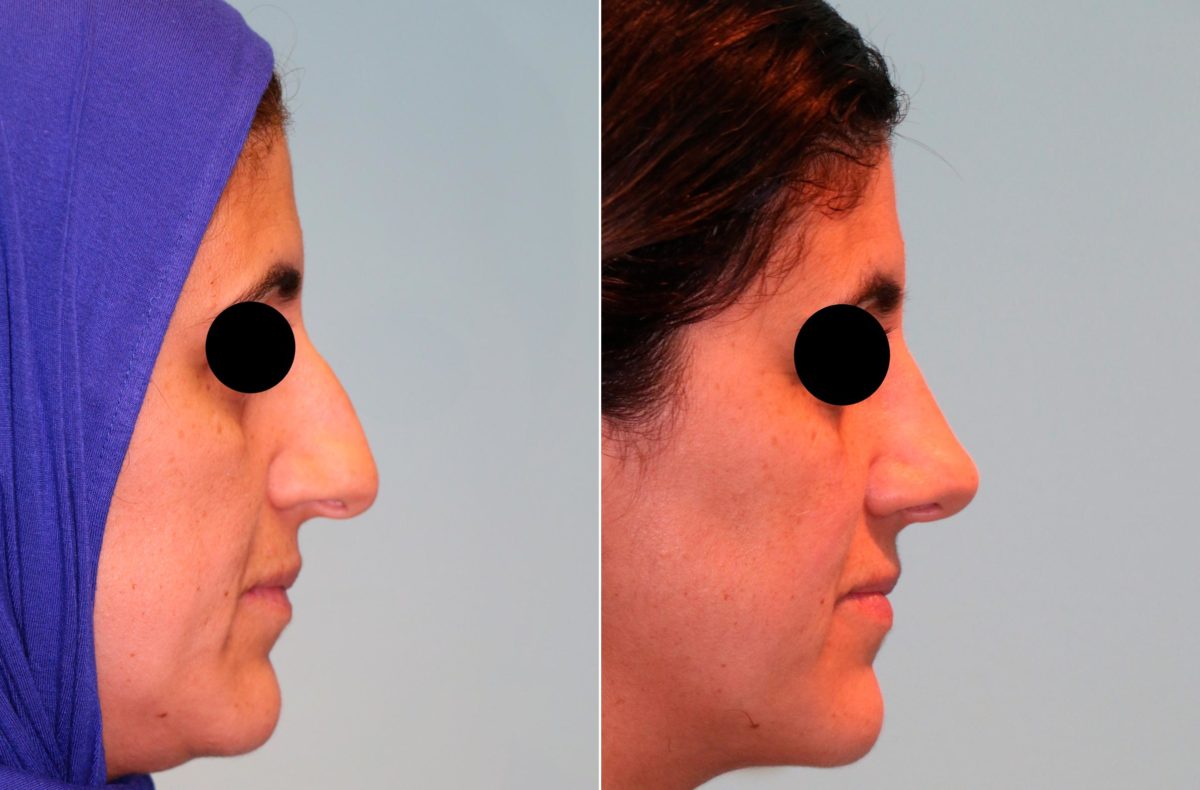 Before and after Rhinoplasty by Dr. Shervin Naderi, Patient 13424