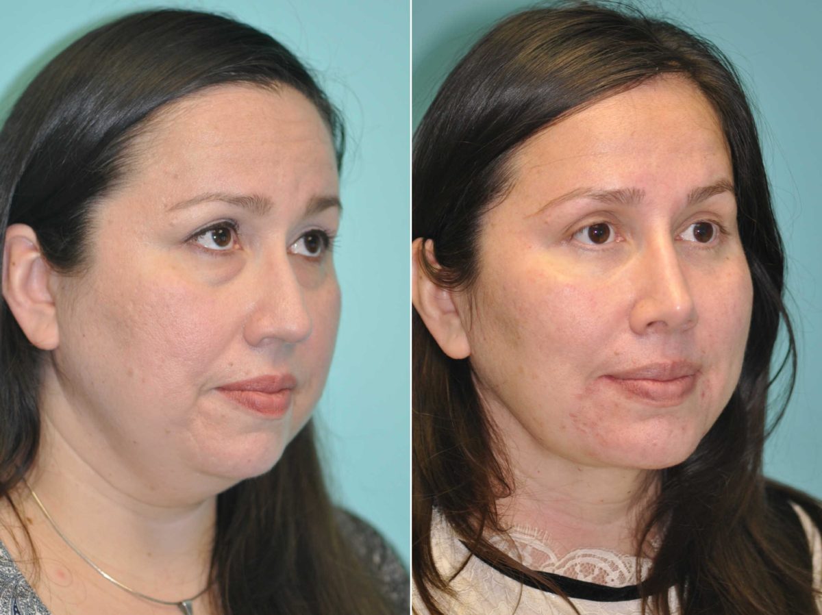 Before and after Rhinoplasty by Dr. Shervin Naderi, Patient 13586