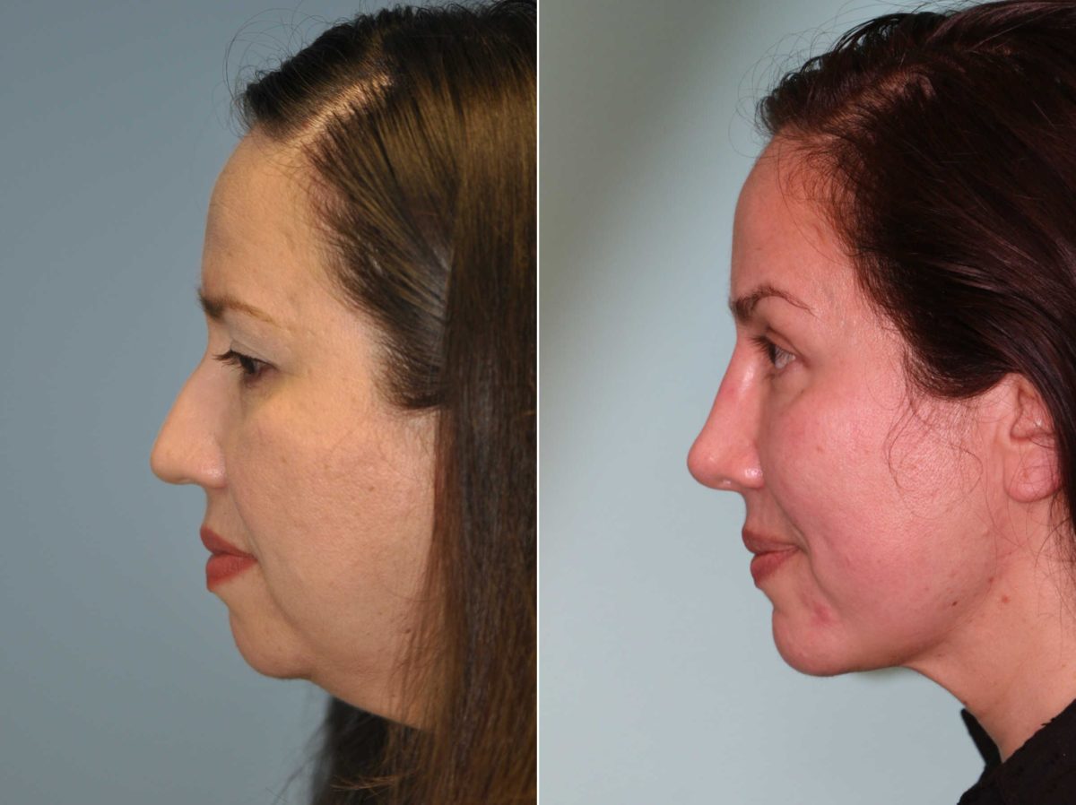 Before and after Rhinoplasty by Dr. Shervin Naderi, Patient 13586