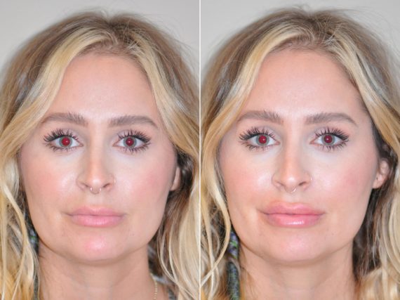 Lip Injections before and after photos in Chevy Chase, MDLip Injections Before and After Photos in Chevy Chase, MD