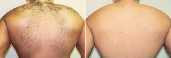 Before and after Laser Hair Removal by Dr. Shervin Naderi, Patient 13761