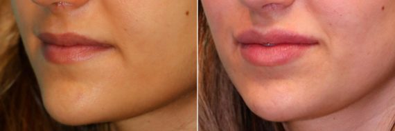 Before and after Lip Augmentation by Dr. Shervin Naderi, Patient 13790