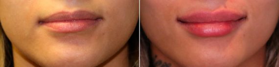 Before and after Lip Augmentation by Dr. Shervin Naderi, Patient 13748