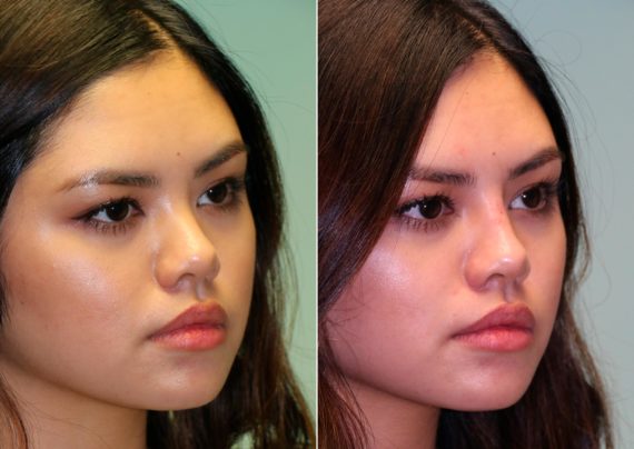 Before and after Non-Surgical Rhinoplasty by Dr. Shervin Naderi, Patient 13737