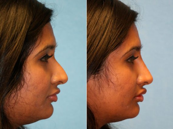 Before and after Non-Surgical Rhinoplasty by Dr. Shervin Naderi, Patient 13794