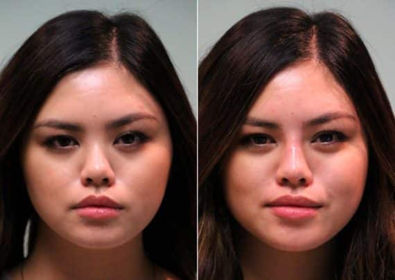 Before and after Non-Surgical Rhinoplasty by Dr. Shervin Naderi, Patient 13737