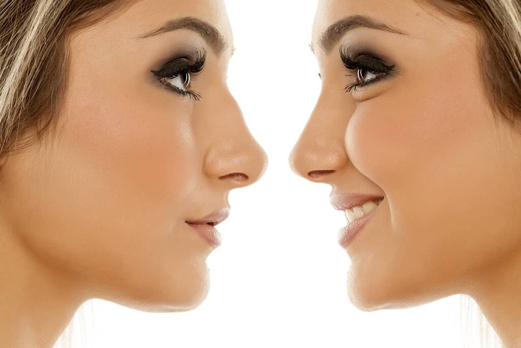 A nasal bridge procedure, a common rhinoplasty technique, may be able to enhance the look of your nose