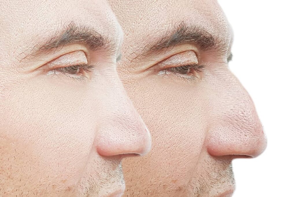 Rhinoplasty surgery can help address nose humps by filing away or smoothing them down.