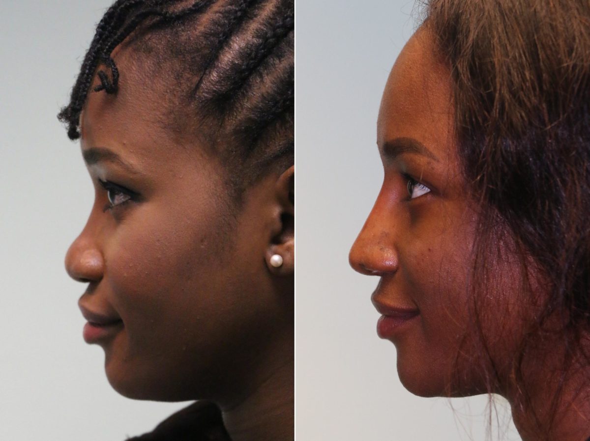 Before and after Rhinoplasty by Dr. Shervin Naderi, Patient 13178