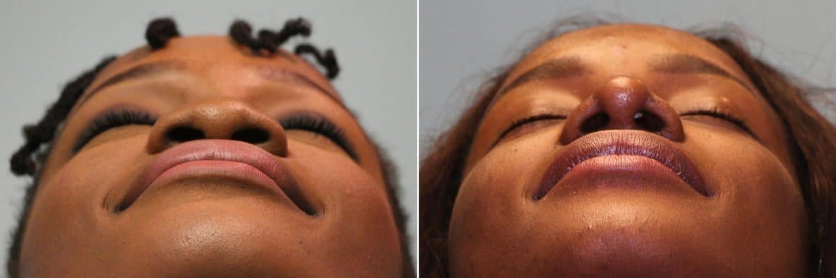 Before and after Rhinoplasty by Dr. Shervin Naderi, Patient 13178