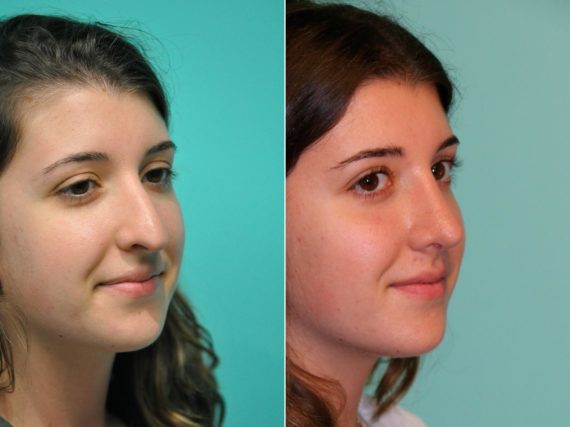 Before and after Rhinoplasty by Dr. Shervin Naderi, Patient 13688