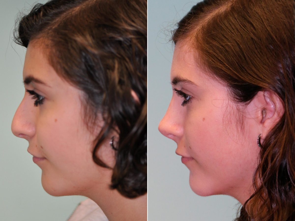 Before and after Rhinoplasty by Dr. Shervin Naderi, Patient 13718