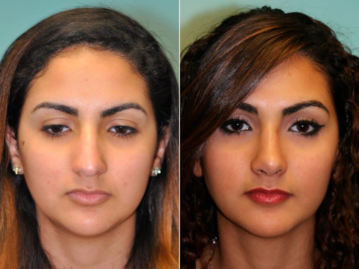 Before and after Rhinoplasty by Dr. Shervin Naderi, Patient 13725