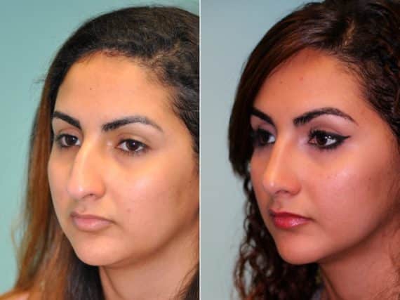 Before and after Rhinoplasty by Dr. Shervin Naderi, Patient 13725