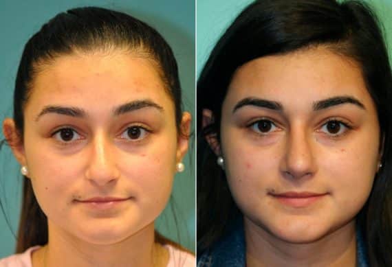 Before and after Rhinoplasty by Dr. Shervin Naderi, Patient 13780