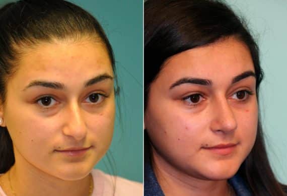 Before and after Rhinoplasty by Dr. Shervin Naderi, Patient 13780