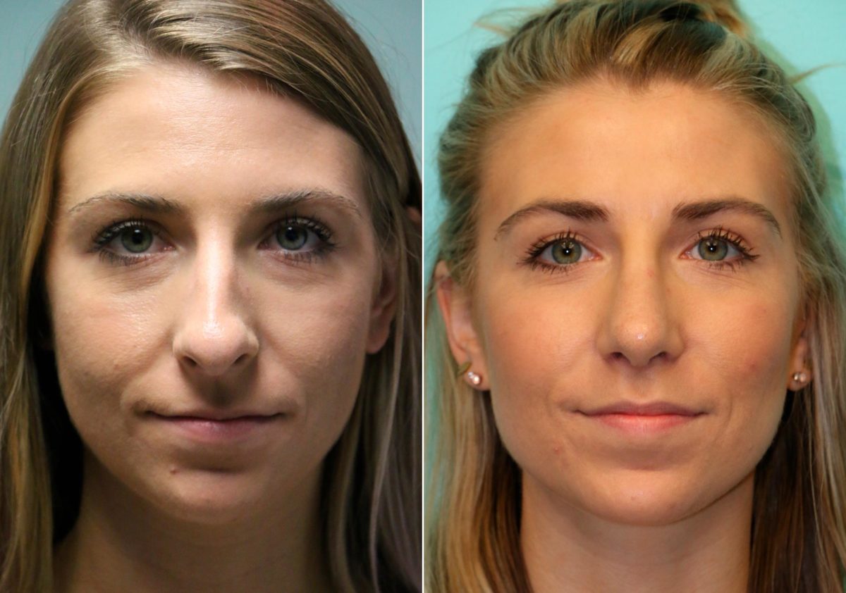 Before and after Rhinoplasty by Dr. Shervin Naderi, Patient 13828