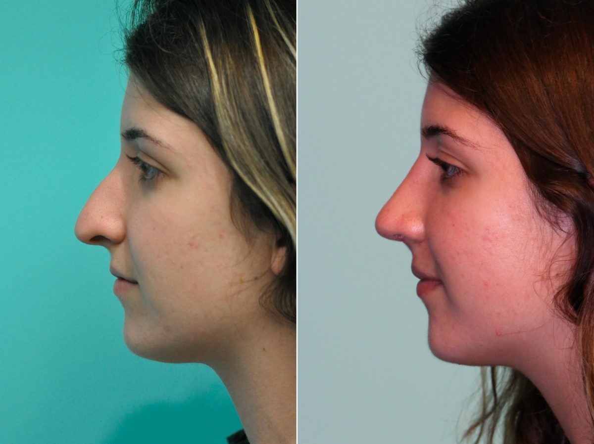 Before and after Rhinoplasty by Dr. Shervin Naderi, Patient 13688