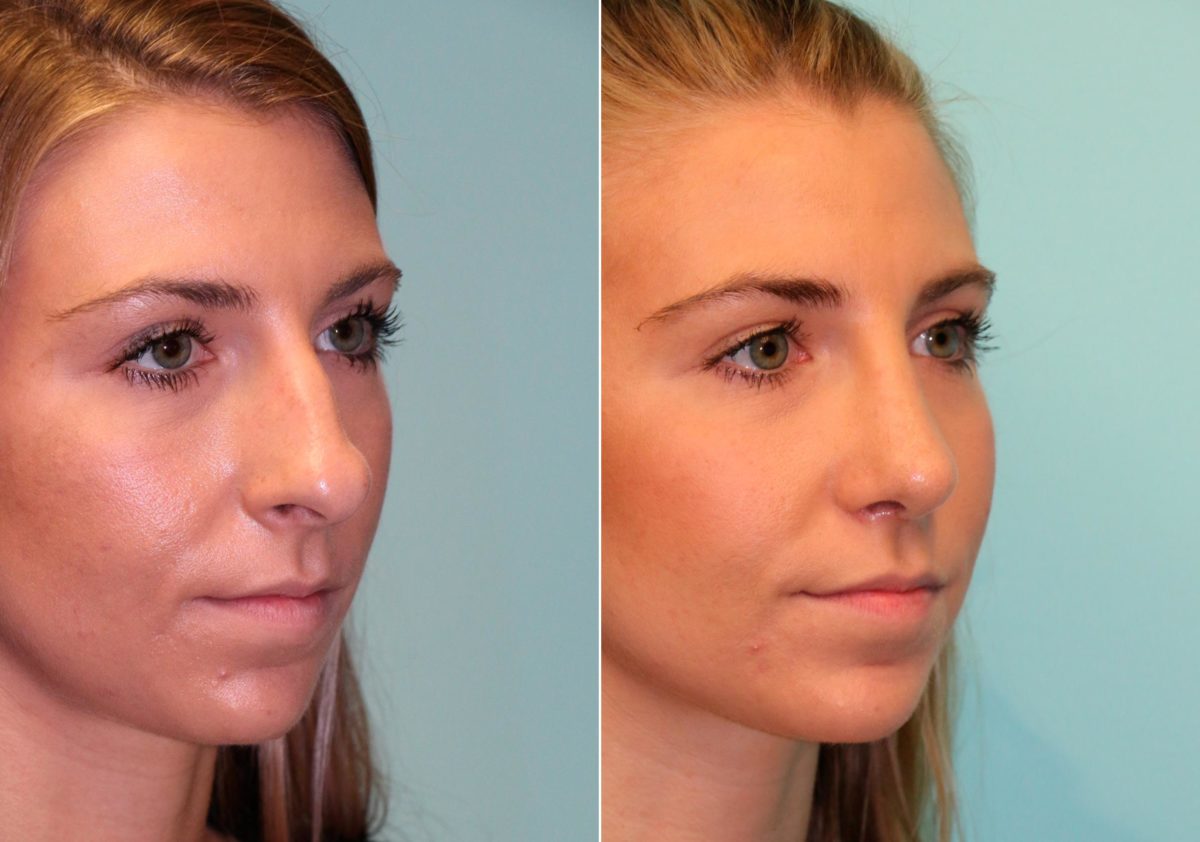 Before and after Rhinoplasty by Dr. Shervin Naderi, Patient 13828