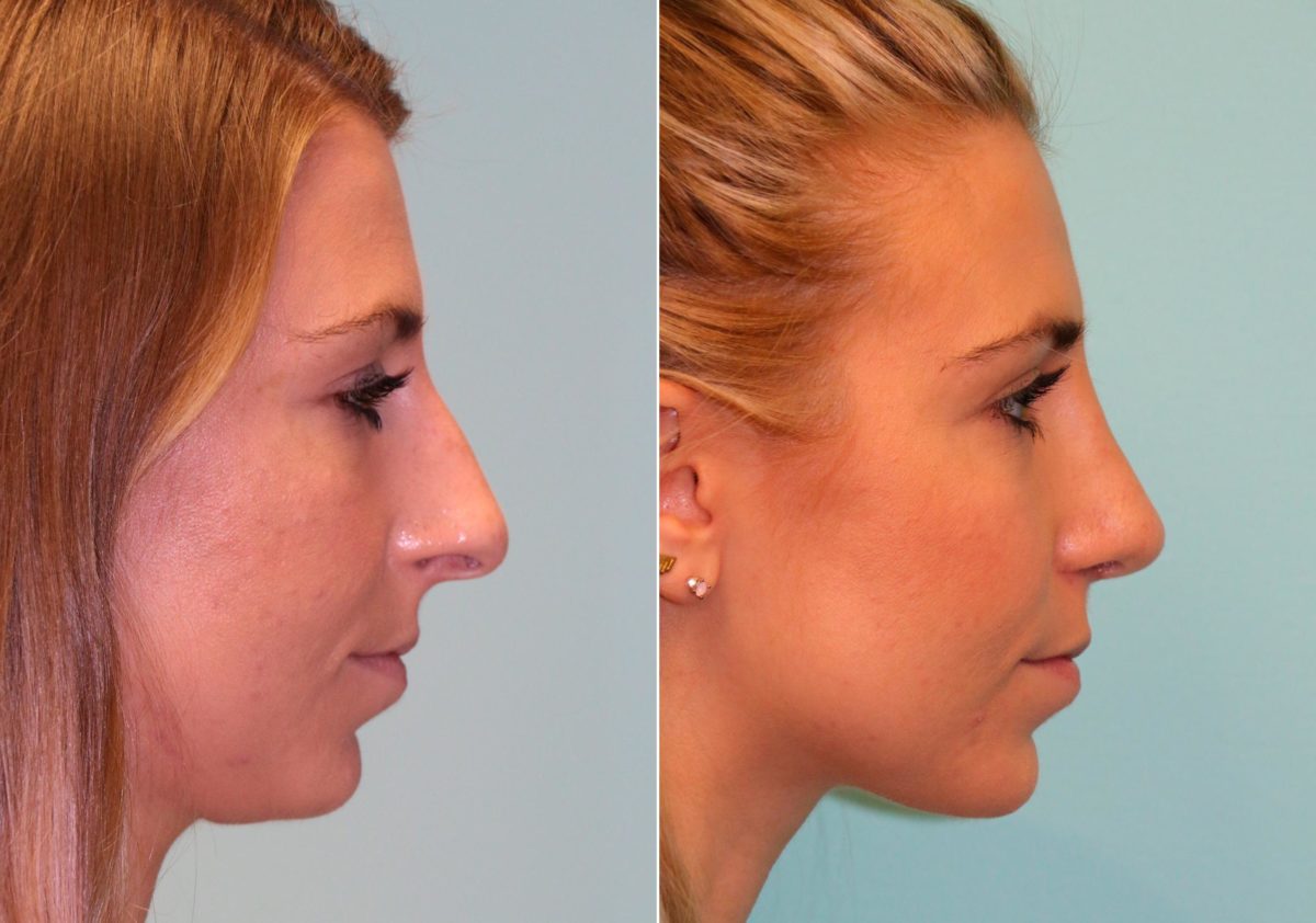 Before and after Rhinoplasty by Dr. Shervin Naderi, Patient 13828