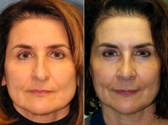 Before and after Rhinoplasty by Dr. Shervin Naderi, Patient 13698