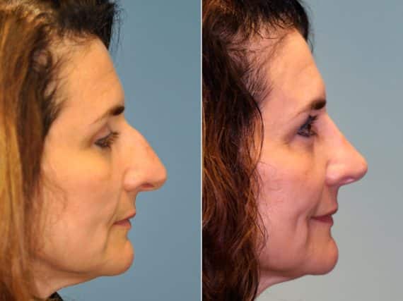 Before and after Rhinoplasty by Dr. Shervin Naderi, Patient 13698