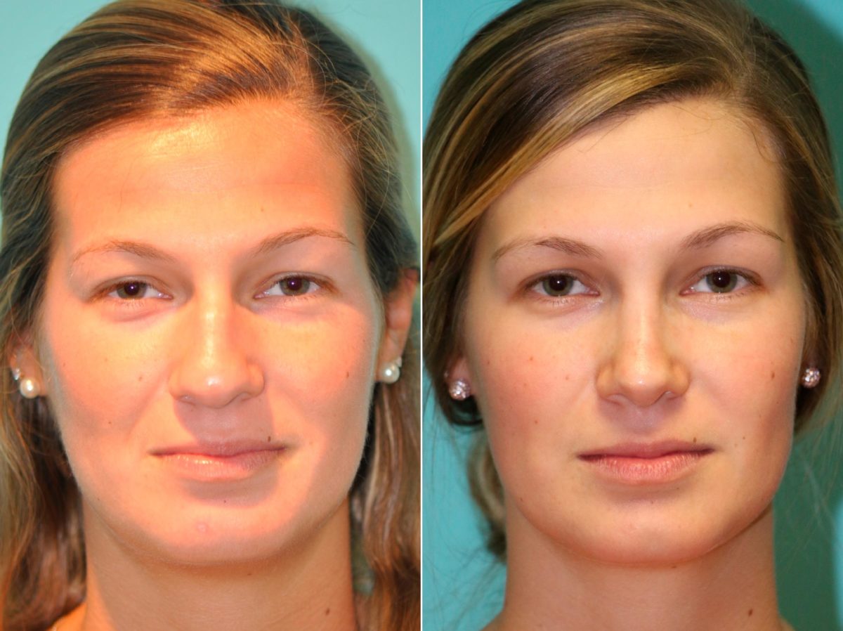 Before and after Rhinoplasty by Dr. Shervin Naderi, Patient 13705