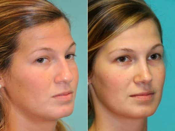 Before and after Rhinoplasty by Dr. Shervin Naderi, Patient 13705