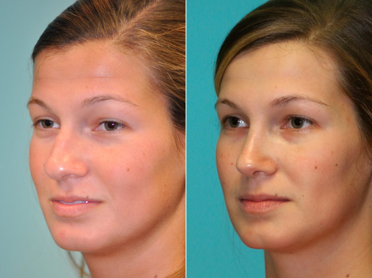 Before and after Rhinoplasty by Dr. Shervin Naderi, Patient 13705