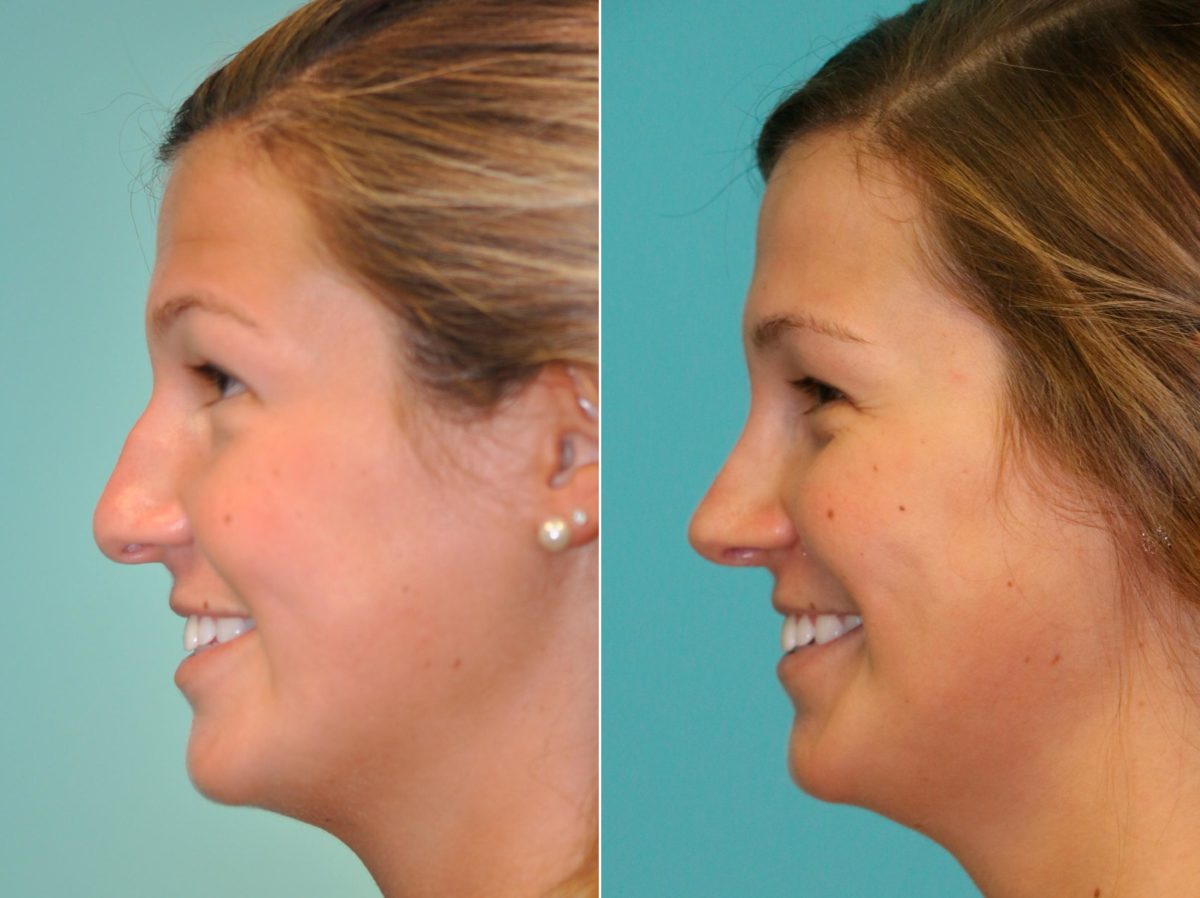 Before and after Rhinoplasty by Dr. Shervin Naderi, Patient 13705