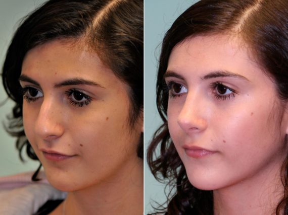 Before and after Rhinoplasty by Dr. Shervin Naderi, Patient 13718