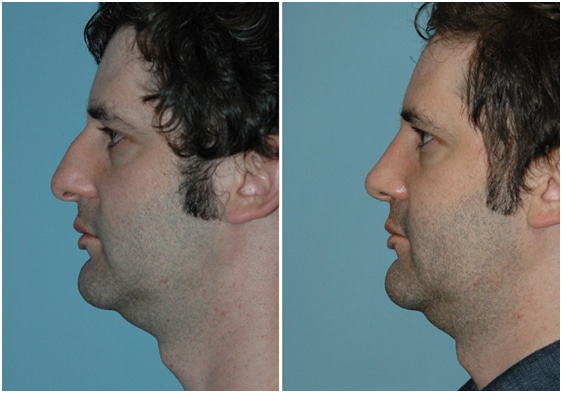 Rhinoplasty Before and After Picture Patient 2 in Virginia