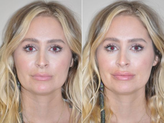 Lip Augmentation Before And After Photos Page 4 Of 6 The Naderi Center For Plastic Surgery