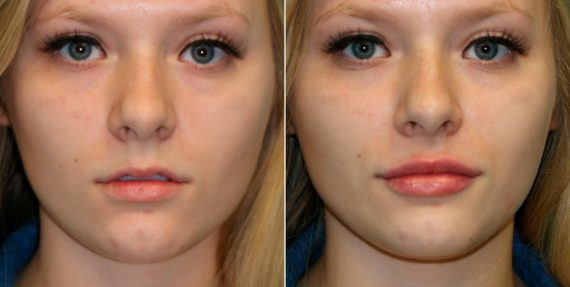 Before and after Lip Augmentation by Dr. Shervin Naderi, Patient 13949