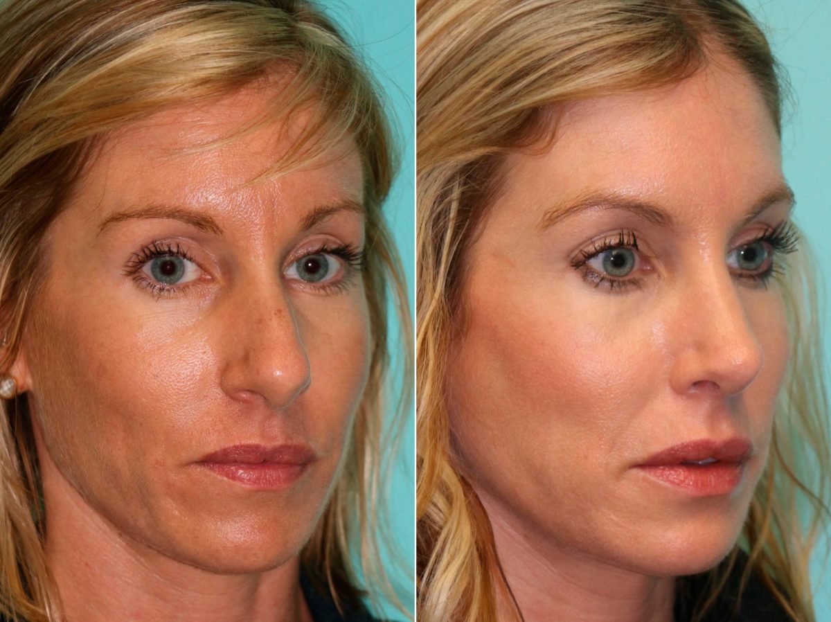 Before and after Rhinoplasty by Dr. Shervin Naderi, Patient 13917